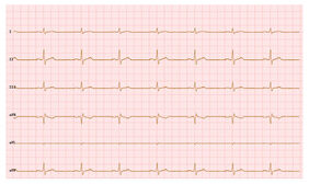HTML5 Canvas心电图波浪线特效